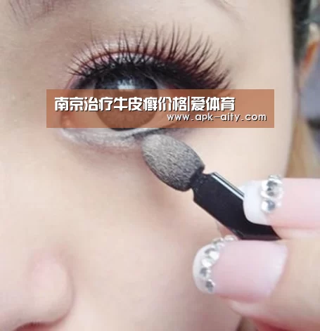 南京治疗牛皮癣价格|爱体育(图1) 爱体育